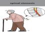 Spinal Stenosis Symptoms