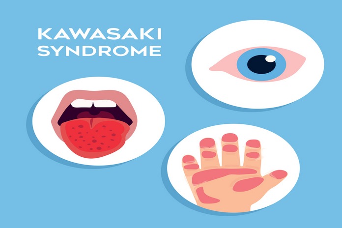 Kawasaki Disease Symptoms Causes Diagnosis And Treatment Page 2 Of 6 Betahealthy 7340