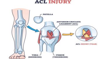 ACL injury