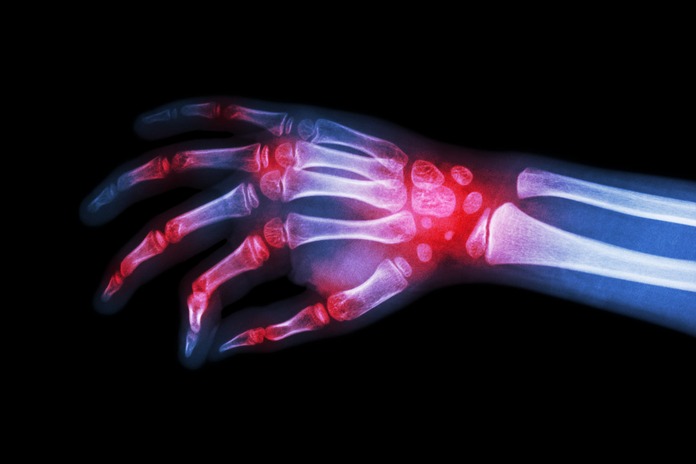 Arthritis and other Inflammatory Conditions