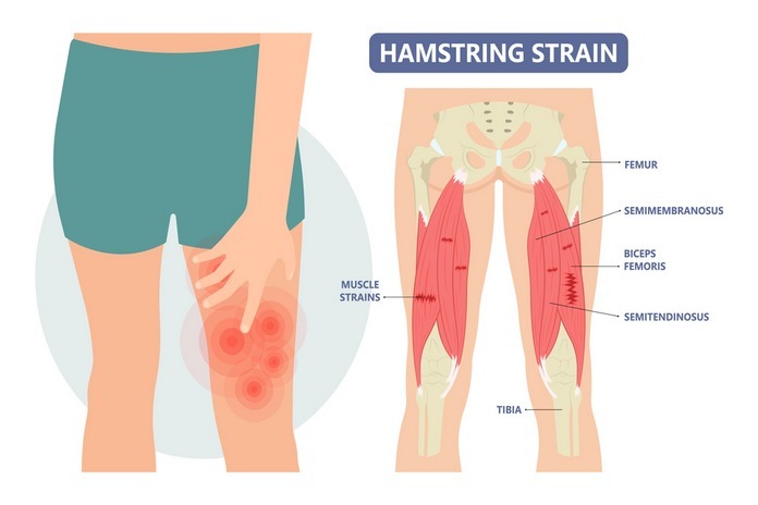 Hamstring Muscle Tears and Strains