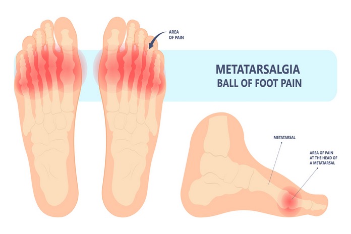 Causes of Pain in The Ball of Your Feet