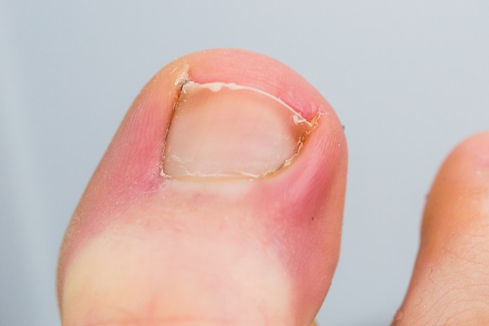 Causes of Toe Pain