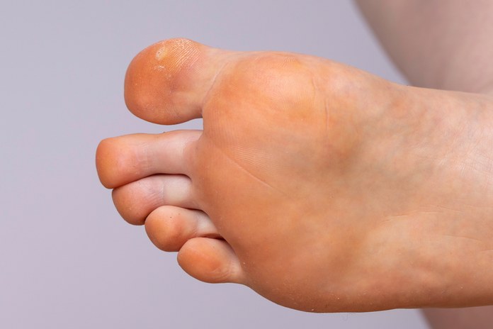Diagnosing Foot Pain Associated with Skin Issues