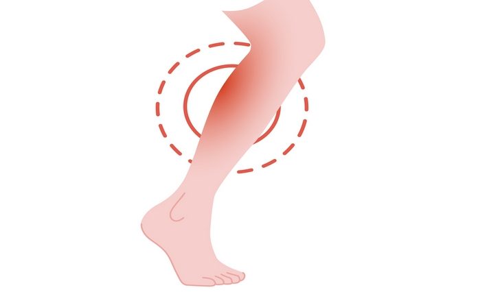 Diagnosis of lower leg pain