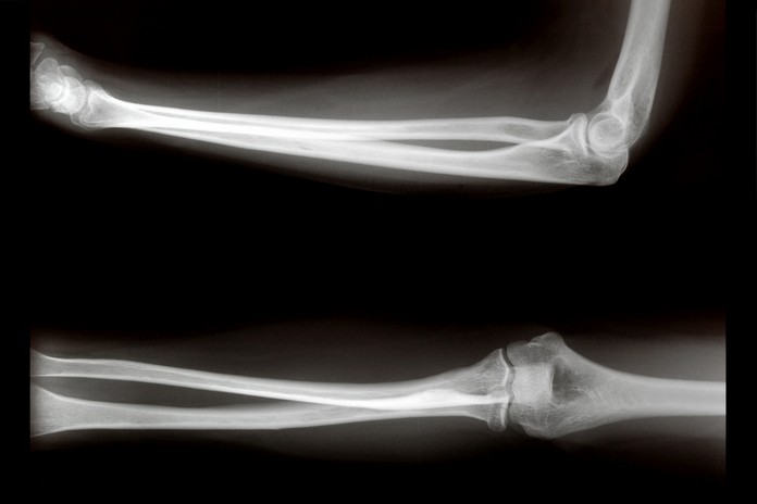Diagnostic imaging for Elbow Pain