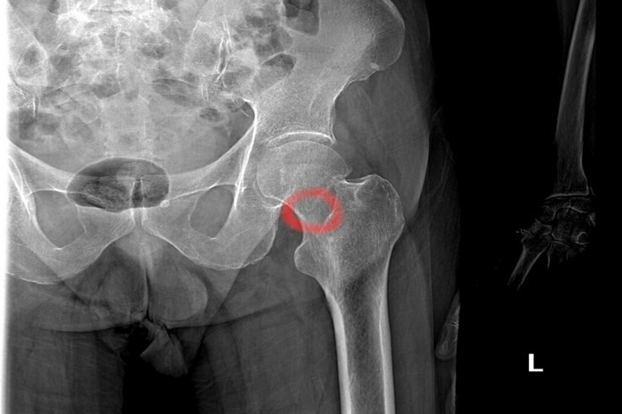Femoral Stress Fractures