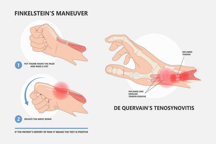 Hand Pain Evaluation
