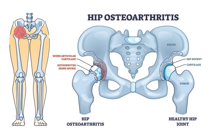 Differential Diagnosis of Hip Pain