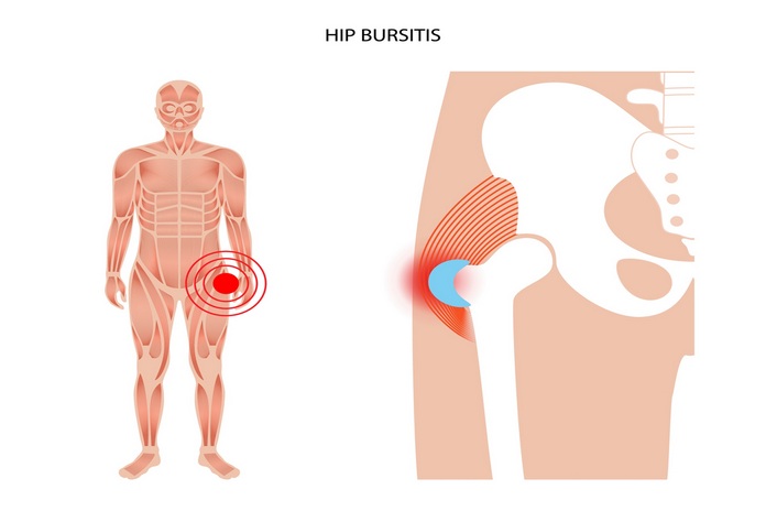 Hip Tendonitis and Bursitis