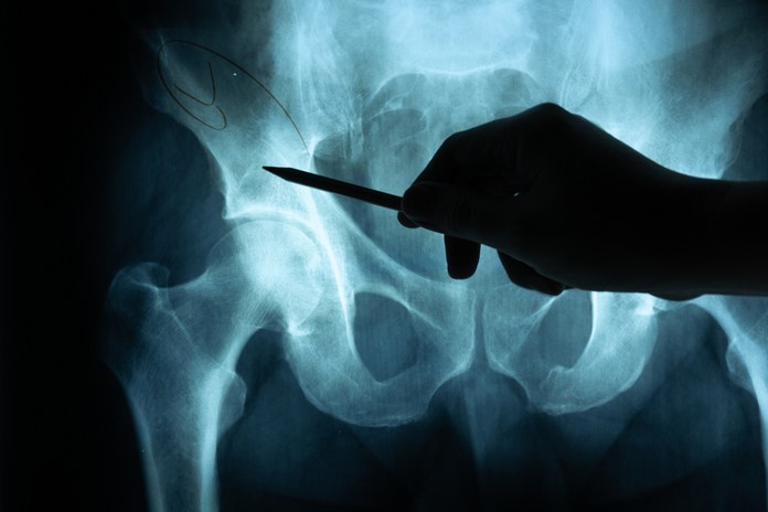Imaging Tests to Diagnose Hip Pain