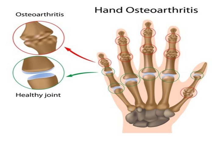 Osteoarthritis
