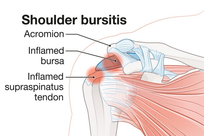 Shoulder bursitis
