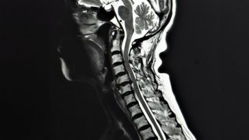 Spinal disc degeneration