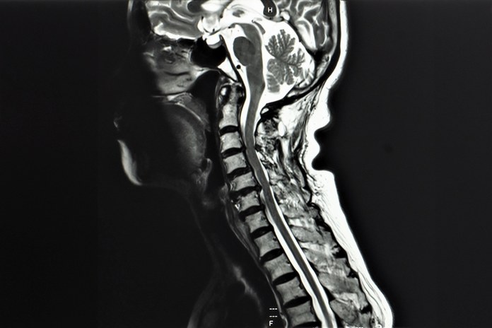 Spinal disc degeneration