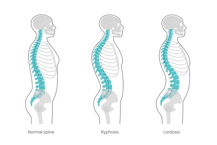 Spinal Misalignments
