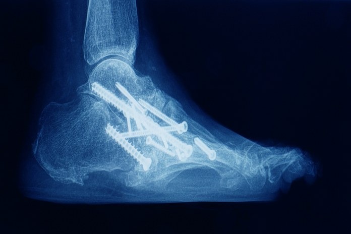 Surgical Procedures For Ankle Pain