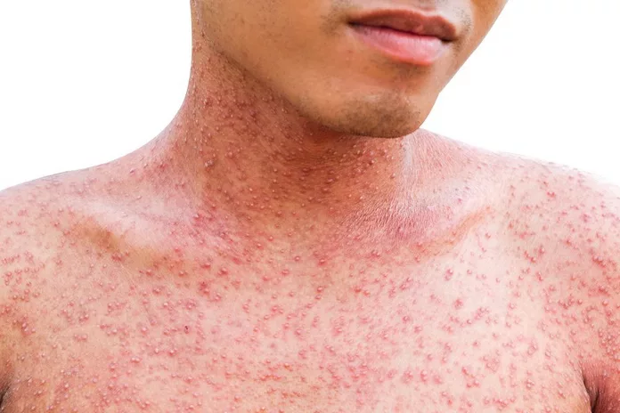 15 Skin Rash Symptoms